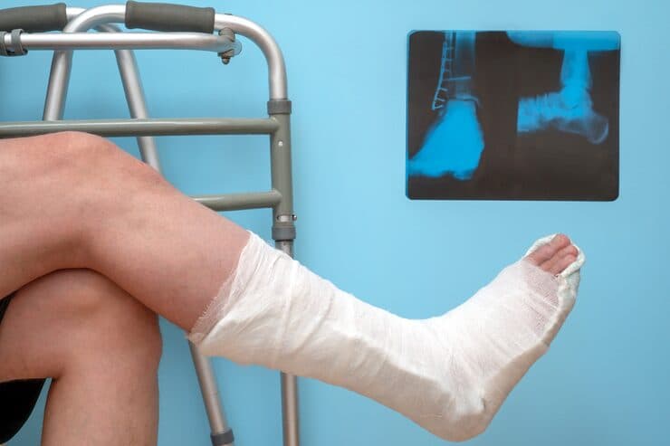 Orthopaedic surgical care for complex fractures